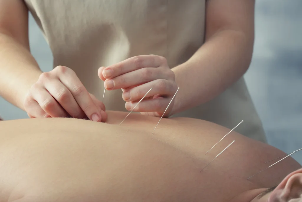 Dry Needling  ฝังเข็มแพทย์แผนจีน Traditional Chinese Acupuncture เทคนิคฝังเข็มแบบตะวันตก